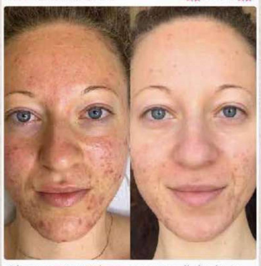 Filter free3